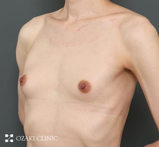 40代男性の豊胸・ボディ形成 Before 症例写真