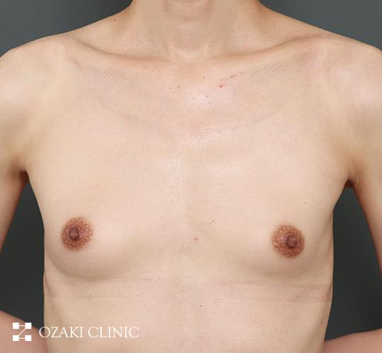 40代男性のMTF豊胸（トランスジェンダー豊胸） Before 症例写真