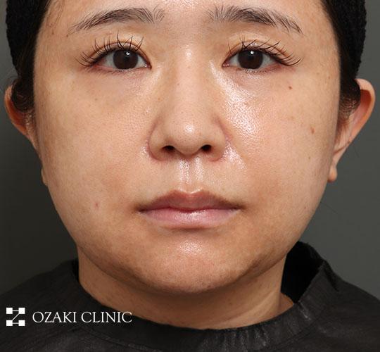 30代女性の顔の脂肪吸引  After 症例写真