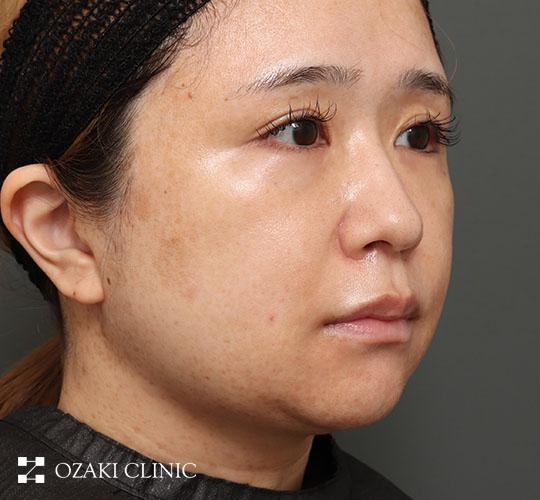 30代女性の顔の脂肪吸引  After 症例写真