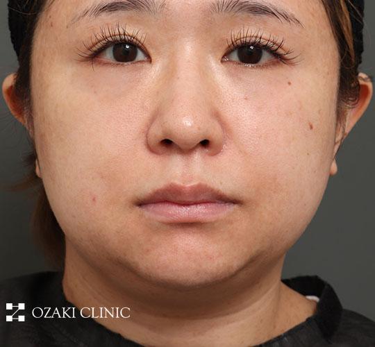 30代女性の顔の脂肪吸引  Before 症例写真