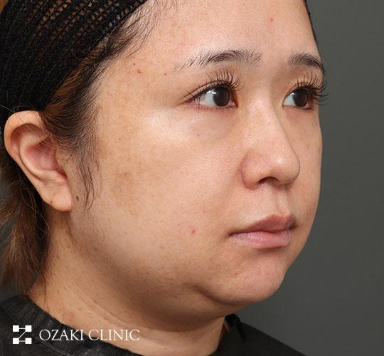 30代女性の顔の脂肪吸引  Before 症例写真
