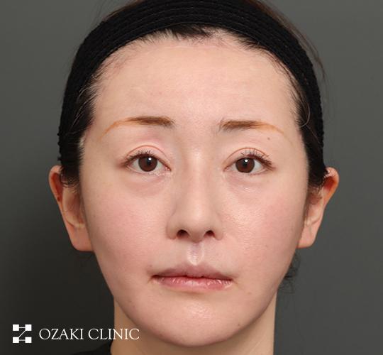 30代女性の額縮小 After 症例写真