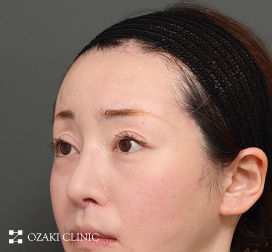 30代女性の額縮小 After 症例写真