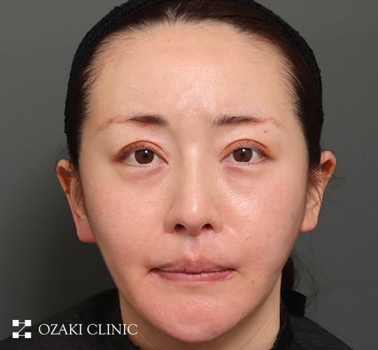 30代女性の額縮小 Before 症例写真