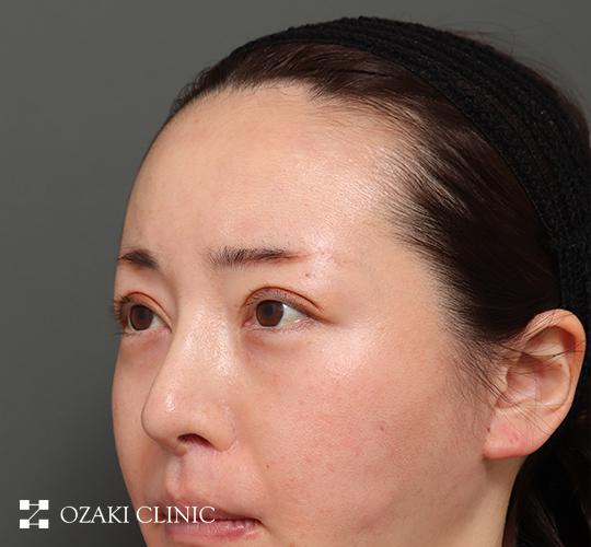 30代女性の額縮小 Before 症例写真