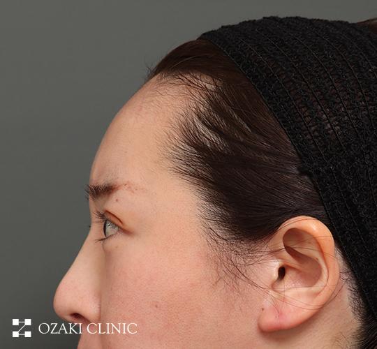 30代女性の額縮小 Before 症例写真