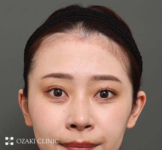 20代女性の額縮小 After 症例写真