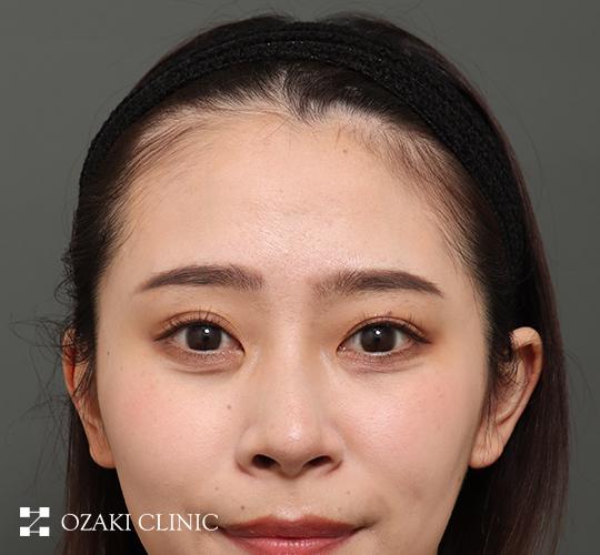 20代女性の額縮小 Before 症例写真