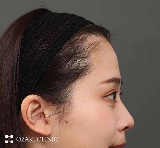 20代女性の額縮小 Before 症例写真
