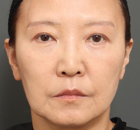 60代女性の目元のたるみ After 症例写真