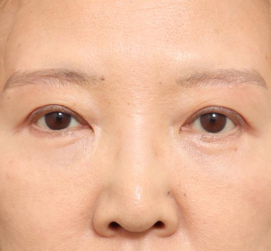60代女性の眉下切開法 After 症例写真