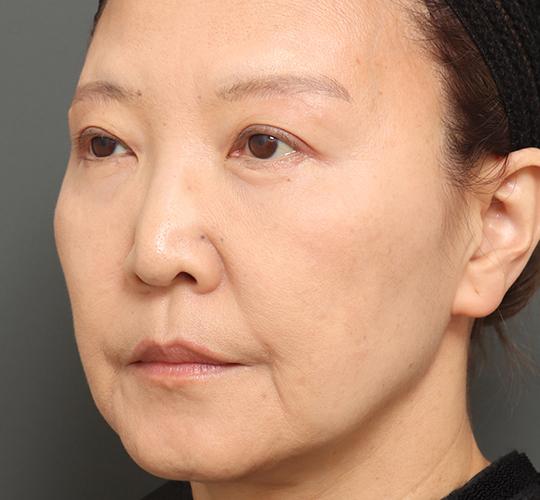 60代女性の眉下切開法 After 症例写真
