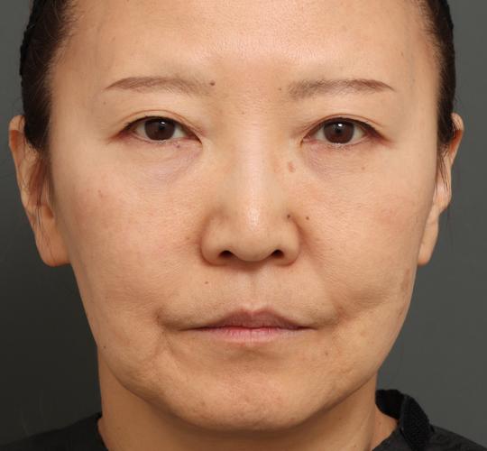 60代女性の目元のたるみ Before 症例写真