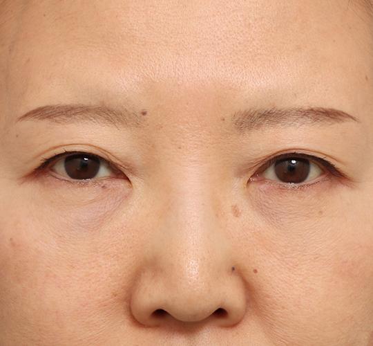 60代女性の眉下切開法 Before 症例写真