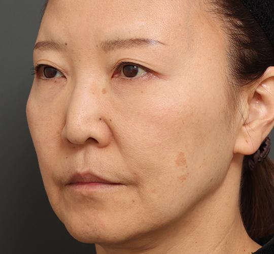 60代女性の眉下切開法 Before 症例写真