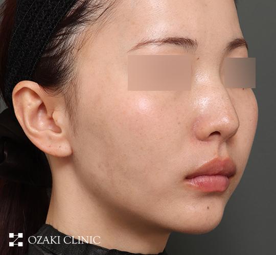 20代女性の顔の脂肪吸引 After 症例写真