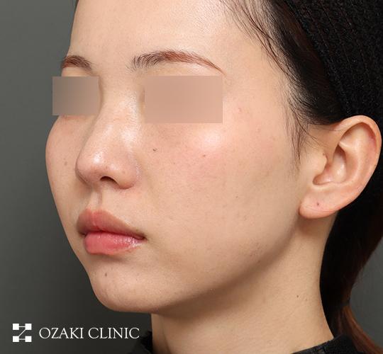 20代女性の顔の脂肪吸引 Before 症例写真