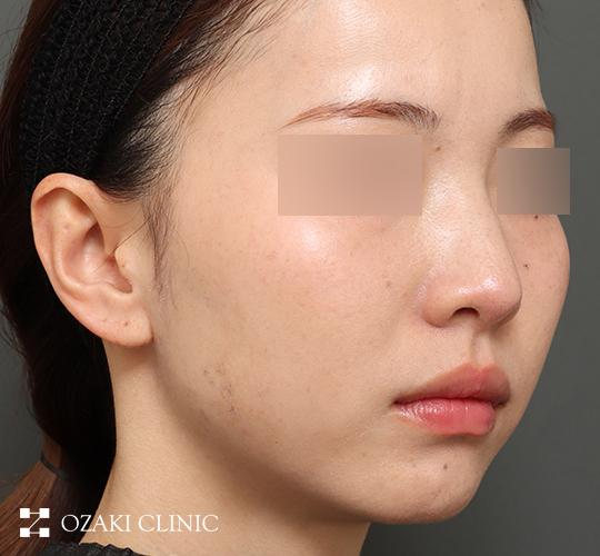 20代女性の顔の脂肪吸引 Before 症例写真