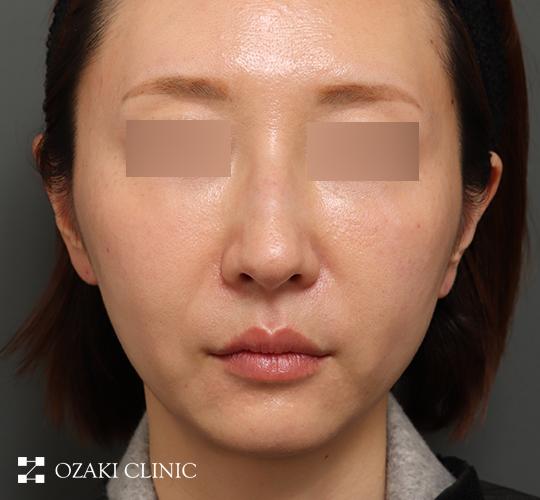 40代女性のヒアルロン酸注射（ほうれい線） Before 症例写真