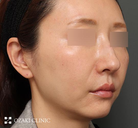 40代女性のエピティコン糸 Before 症例写真
