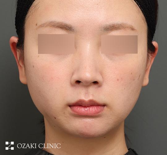 30代女性の顔の脂肪吸引 After 症例写真