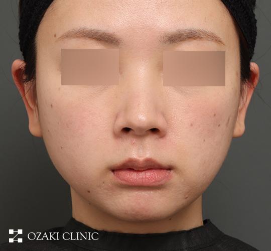 30代女性の顔の脂肪吸引 Before 症例写真