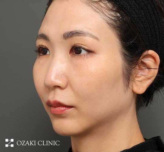 30代女性の顔の脂肪吸引  After 症例写真