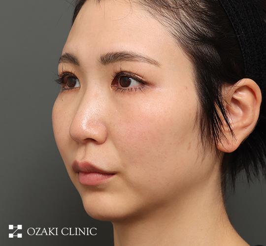 30代女性の顔の脂肪吸引  Before 症例写真