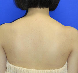 20代女性のその他 After 症例写真