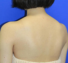 20代女性のボトックス（美肩・肩こり解消） After 症例写真