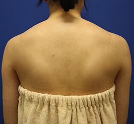 20代女性のその他 Before 症例写真