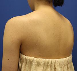 20代女性のボトックス（美肩・肩こり解消） Before 症例写真