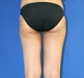 30代女性の脂肪吸引 After 症例写真