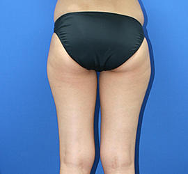 30代女性の脂肪吸引 Before 症例写真