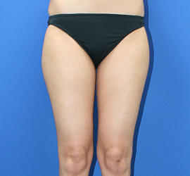 30代女性の脂肪吸引 Before 症例写真