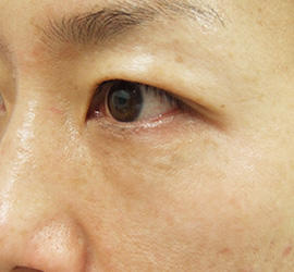 40代女性のPRP皮膚再生療法 After 症例写真