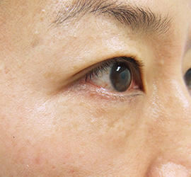 40代女性のPRP皮膚再生療法 After 症例写真