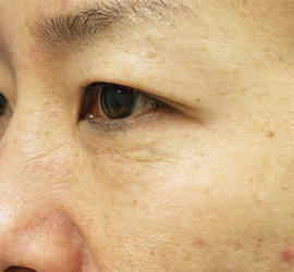 40代女性のPRP皮膚再生療法 Before 症例写真