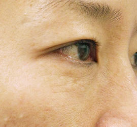 40代女性のPRP皮膚再生療法 Before 症例写真