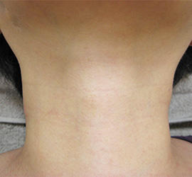 30代女性のPRP皮膚再生療法 After 症例写真