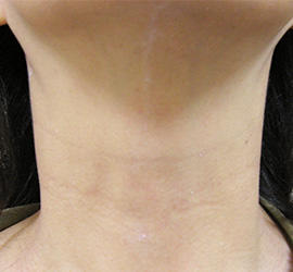 30代女性のPRP皮膚再生療法 Before 症例写真