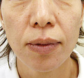40代女性のサーマクール Before 症例写真