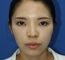 30代女性のダブロ ゴールド After 症例写真