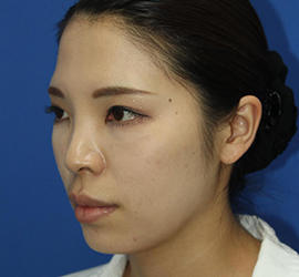 30代女性のダブロ ゴールド After 症例写真