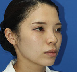 30代女性のダブロ ゴールド After 症例写真