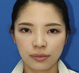 30代女性のダブロ ゴールド Before 症例写真