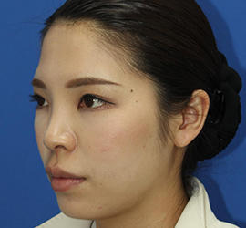 30代女性のダブロ ゴールド Before 症例写真