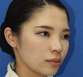 30代女性のダブロ ゴールド Before 症例写真