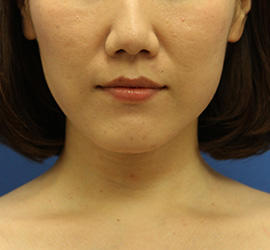 30代女性の顔の脂肪吸引  After 症例写真